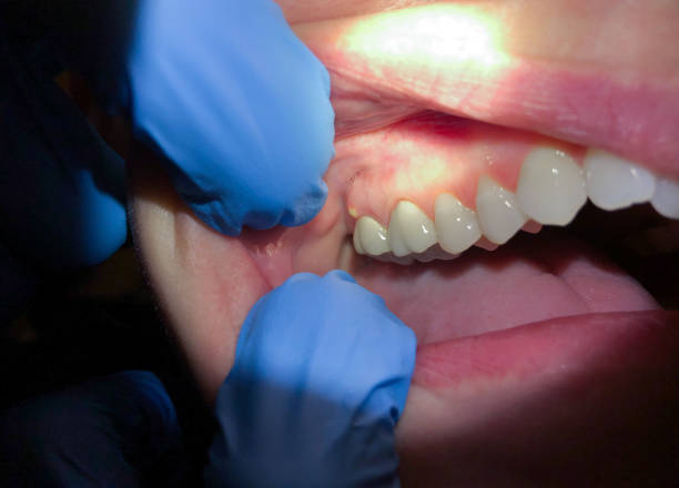 Best Emergency Dental Extractions in Montesano, WA